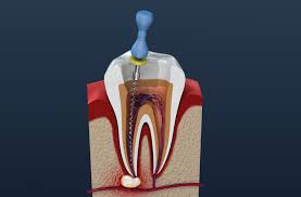 Root-Canal-Dentistry